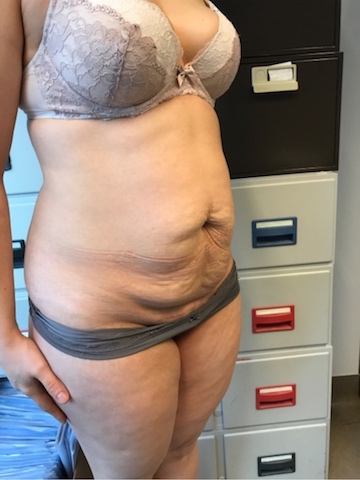 Abdominoplastie - buikwandcorrectie