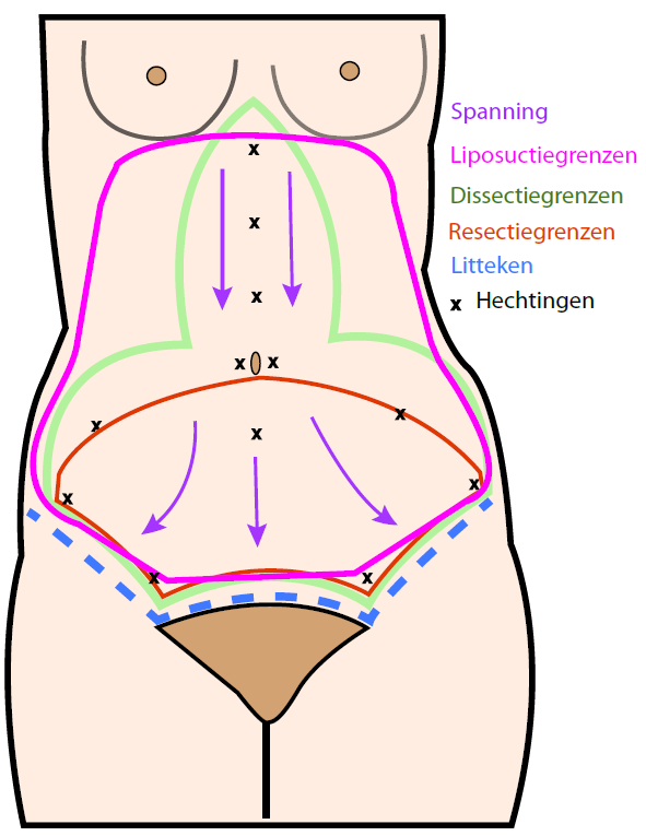 Abdominoplastie - buikwandcorrectie