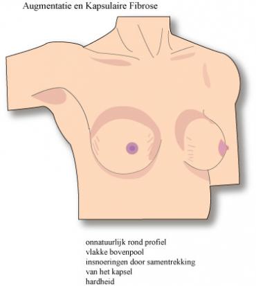 Verharding van de borsten na borstvergroting
